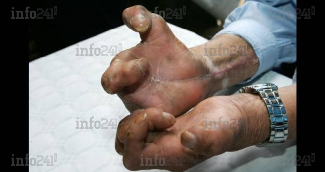 Journée mondiale&nbsp;: la lèpre, une maladie toujours pas éradiquée